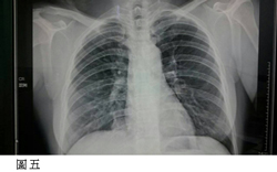  肺癌胸腔鏡微創手術