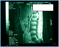  病例介紹-脊椎腫瘤