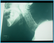  病例介紹-僵質性脊椎炎病患，外傷後頸椎移位