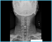  病例介紹-經頸椎前位減壓及人工頸間盤置入手術，恢復良好