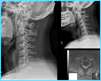  病例介紹-頸椎前位融合手術(1-4節)