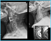  病例介紹-頸椎前位融合手術(1-4節)