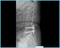  病例介紹-經後位腰椎減壓骨內固定及骨融合手術治療，恢復良好